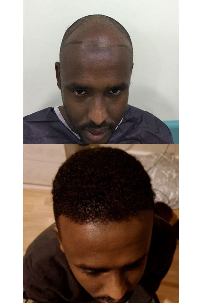 Trapianto di capelli afro presso Smile Hair Clinic al Moodist Hospital