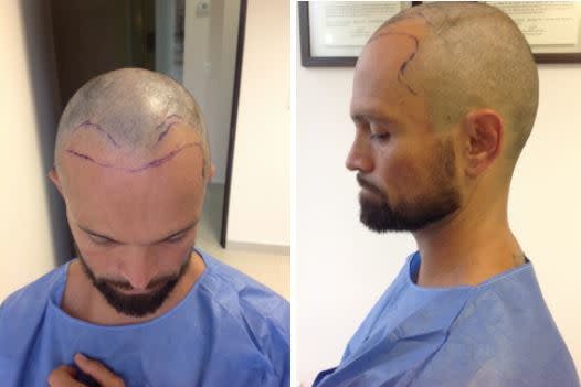 Image1_Freddy’s Hair Transplant Journey – Part 2: During Treatment