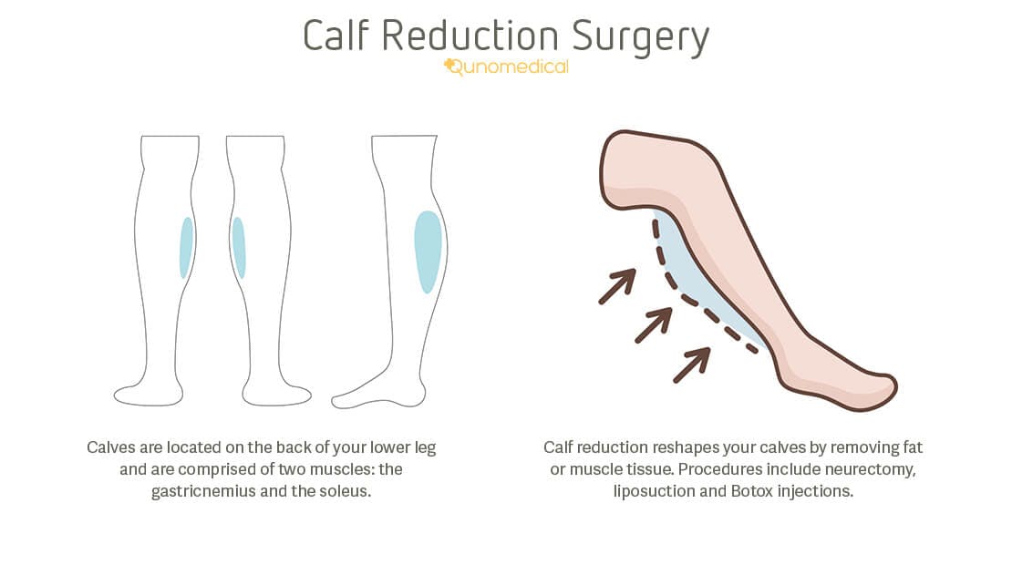 Calf Reduction Surgery At Home & Abroad