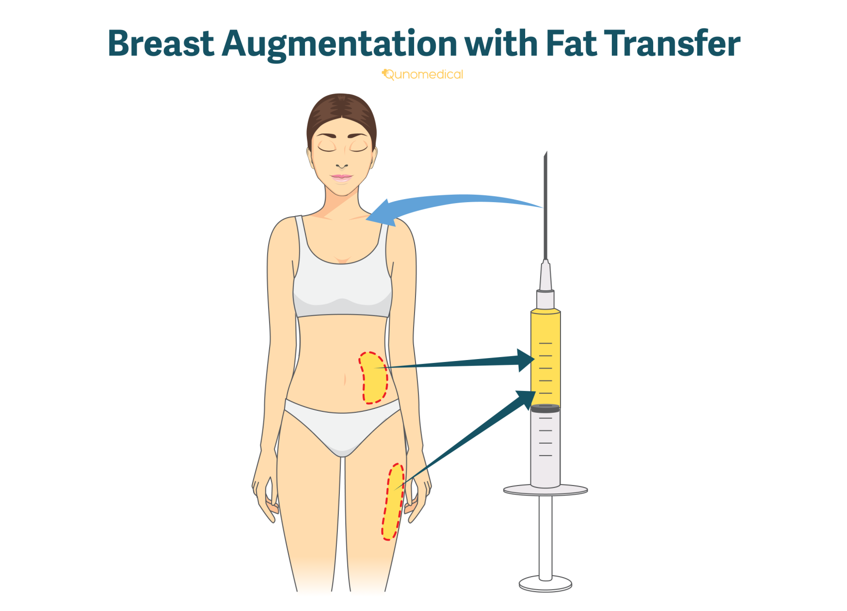 An illustration of how breast augmentation with fat transfer works.