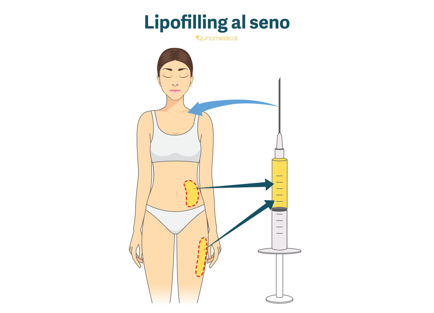 L'illustrazione mostra come funziona il lipofilling al seno.