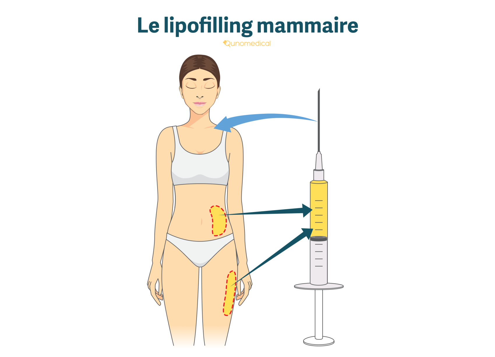 Illustration montrant comment se déroule un lipofilling mammaire.