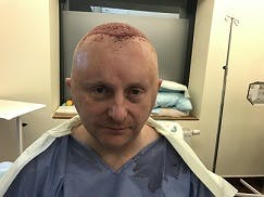 Image5_Eamon’s Hair Transplant Journey - Part II: During Treatment