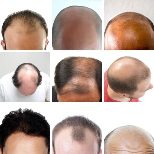 Different types of balding types