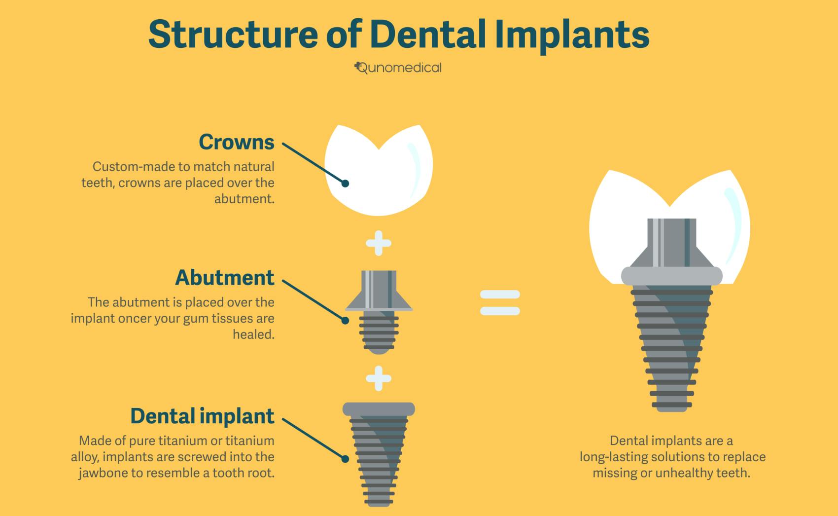 Diagram showing the structure of a dental implant.