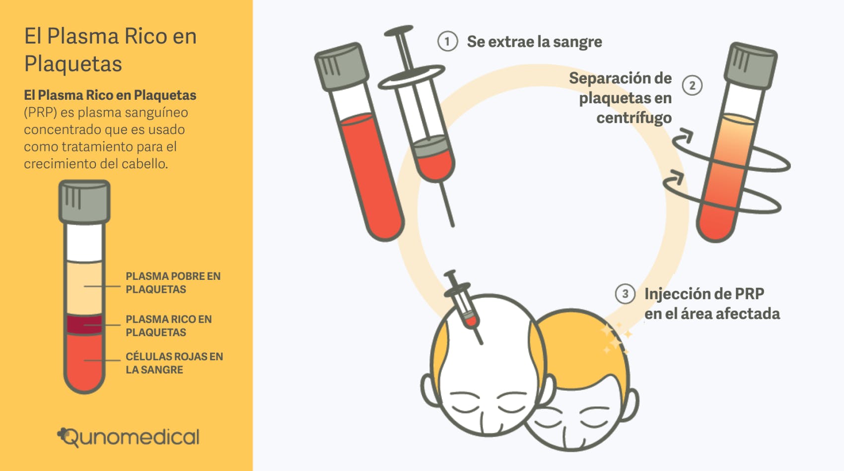 Diagrama que muestra el rol del plasma rico en plaquetas en la cirugía de restauración de cabello.