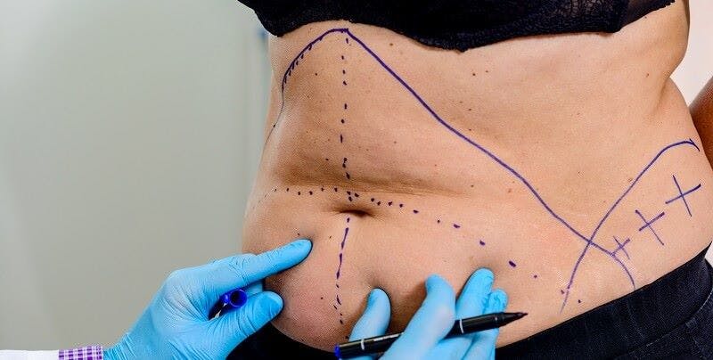 An Overview of the tummy tuck procedure