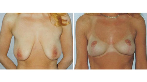 Woman facing camera showing breasts before and after undergoing breast lift surgery.
