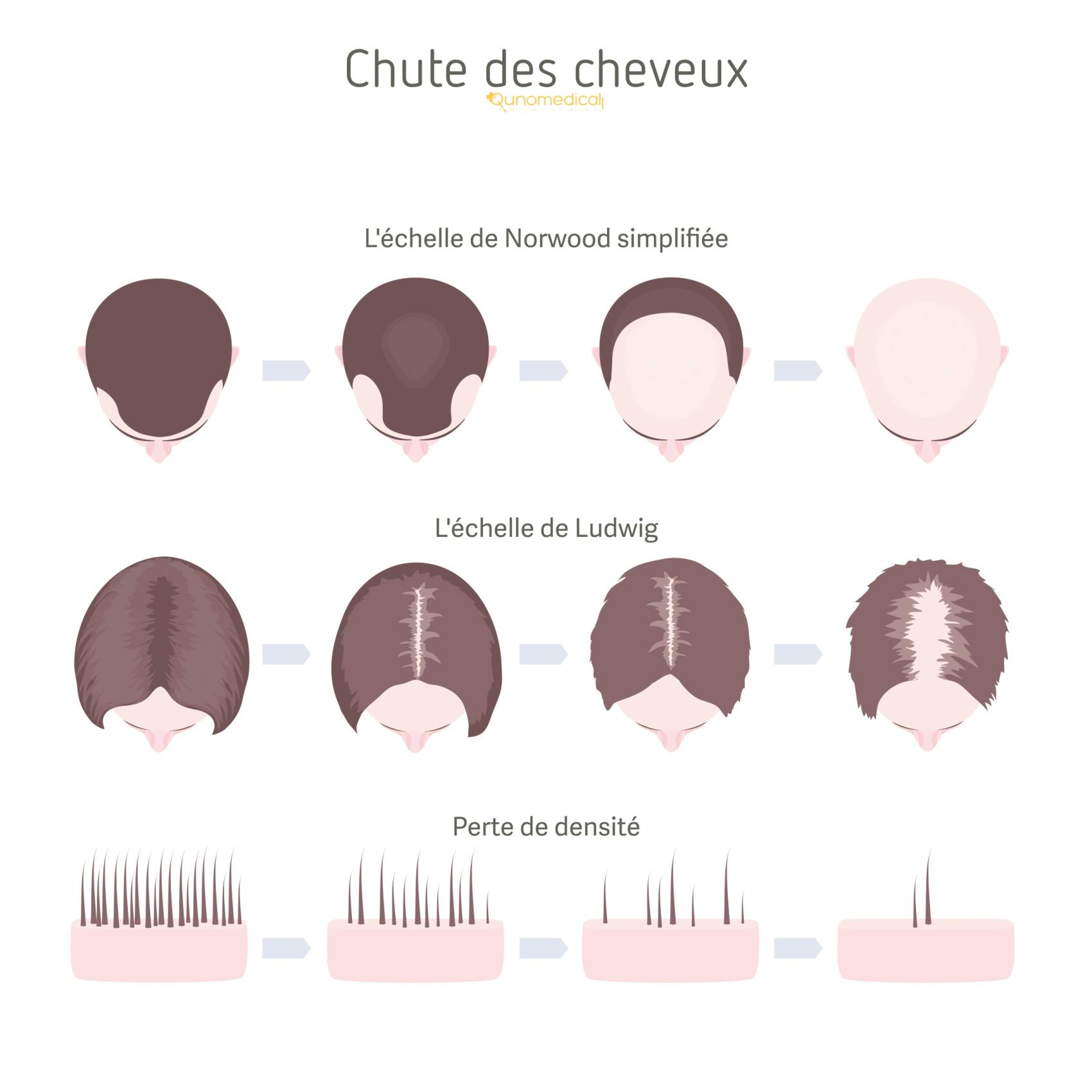 Illustration montrant les différents types de perte de cheveux chez les femmes.