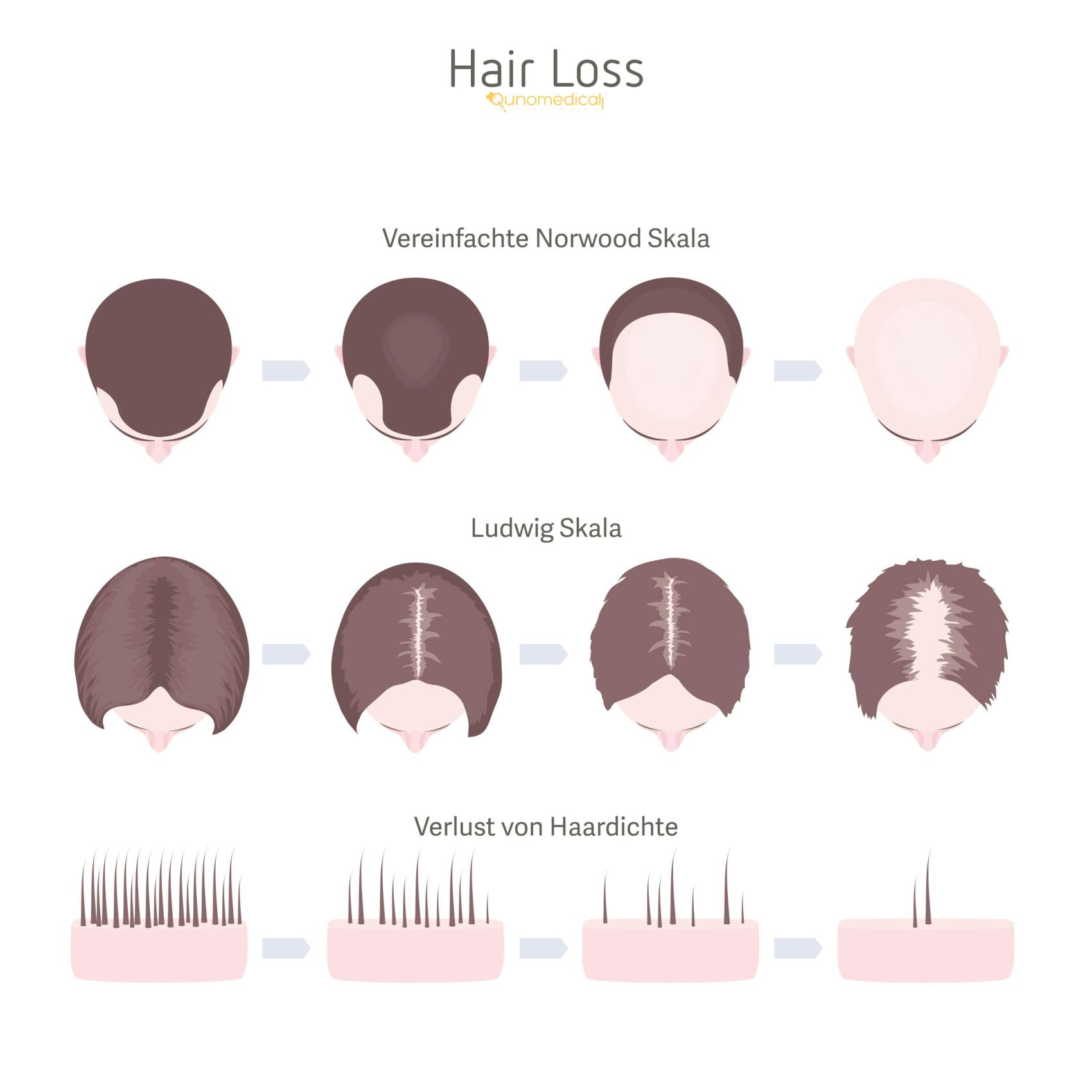 Illustration, die die verschiedenen Arten des weiblichen Haarausfalls zeigt.