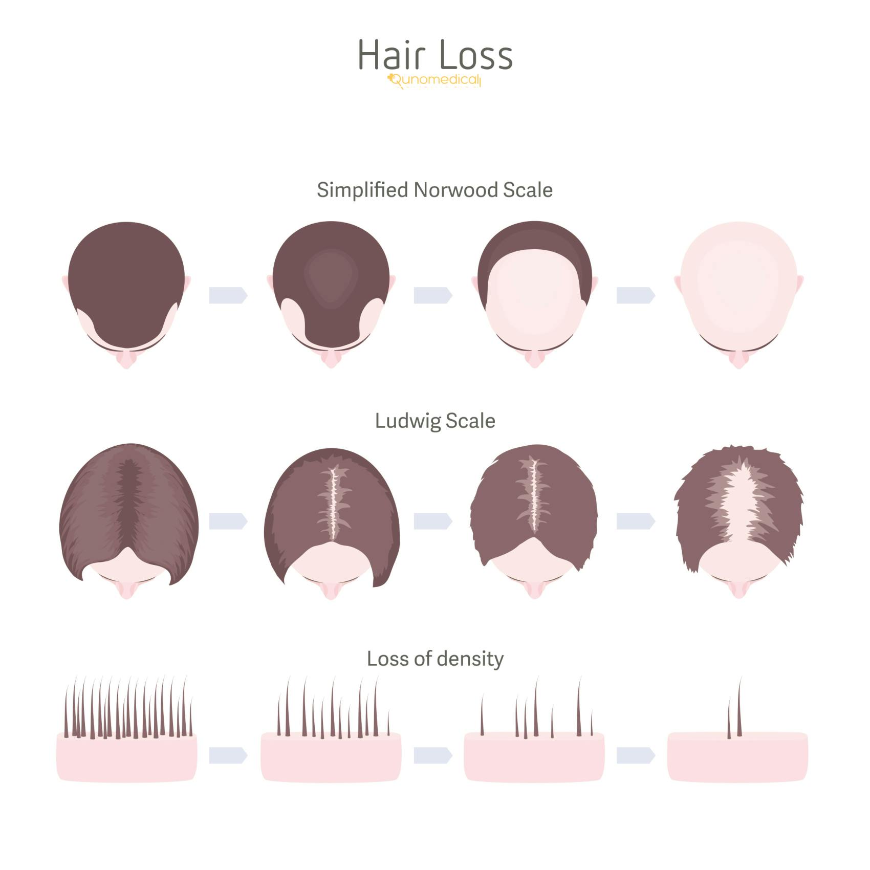 Illustration showing the different types of female hair loss.