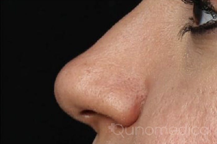 Nase einer Patientin nach einer Nasenkorrektur