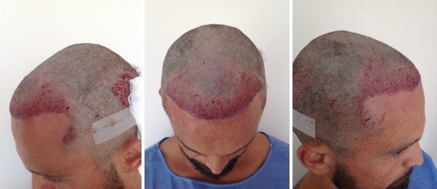 Image2_Freddy’s Hair Transplant Journey – Part 2: During Treatment