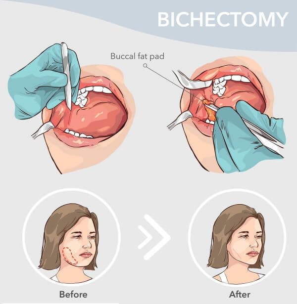 Overview of a bichetomy procedure