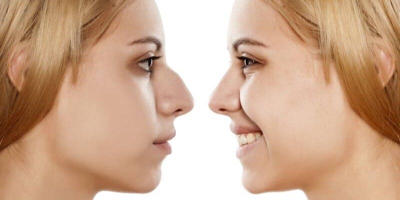Before and after an open or closed rhinoplasty