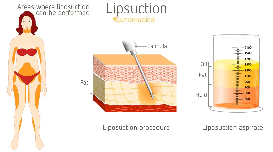 EN image 1 for Liposuction Cost Guide