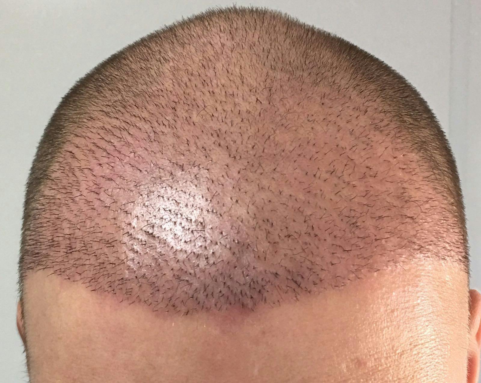 Image2_Patient Stories: Charles’s Hair Transplant - 5 Months Later