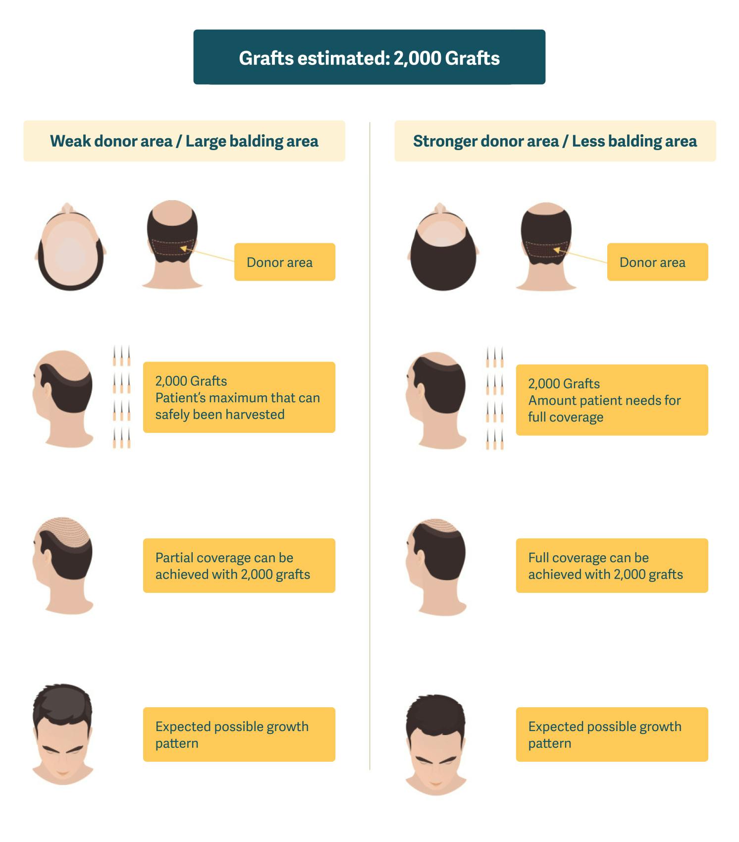 Illustration showing the possibilities of achieving full coverage from a 2,000 graft hair transplant.