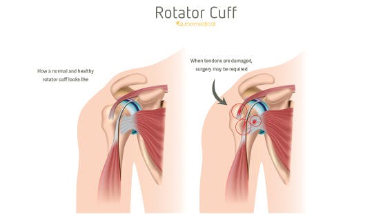 Illustration showing the difference between a healthy and damaged rotator cuff.