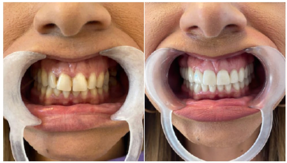 Patient showing teeth before and after having dental veneers fitted.