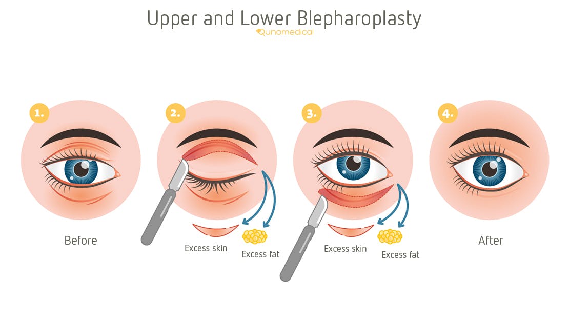 TP_blepharoplasty-how-it-works