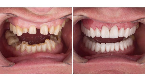 Patient showing their teeth before and after having zirconia dental crowns fitted.