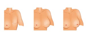 Illustration of an example of a reconstructive breast surgery treatment.
