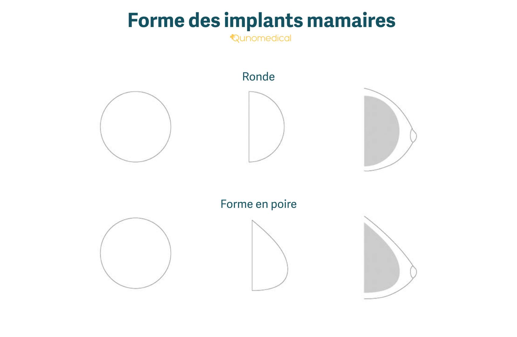 Les différentes formes d'implants mammaires.