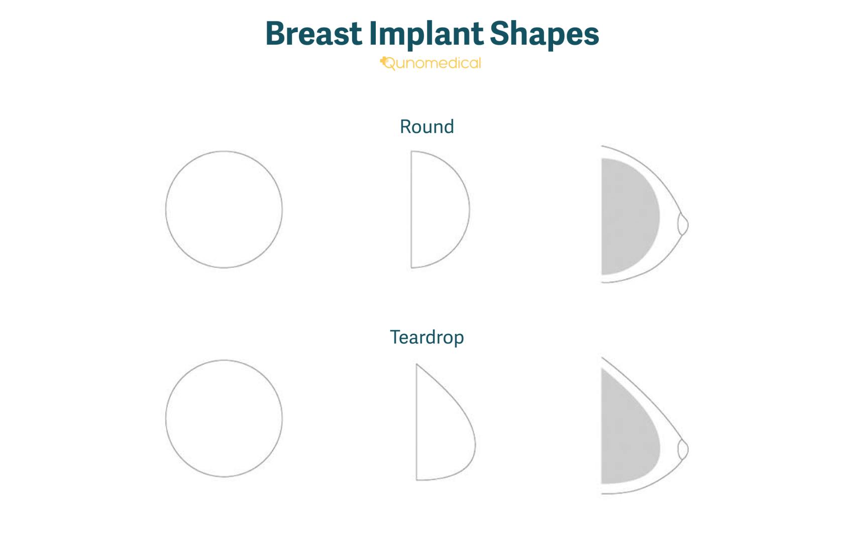 The different shapes of breast implants.