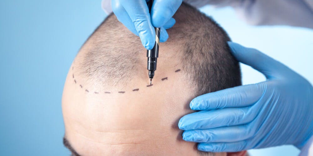 Best hair transplant surgeon in Turkey works on a men's head