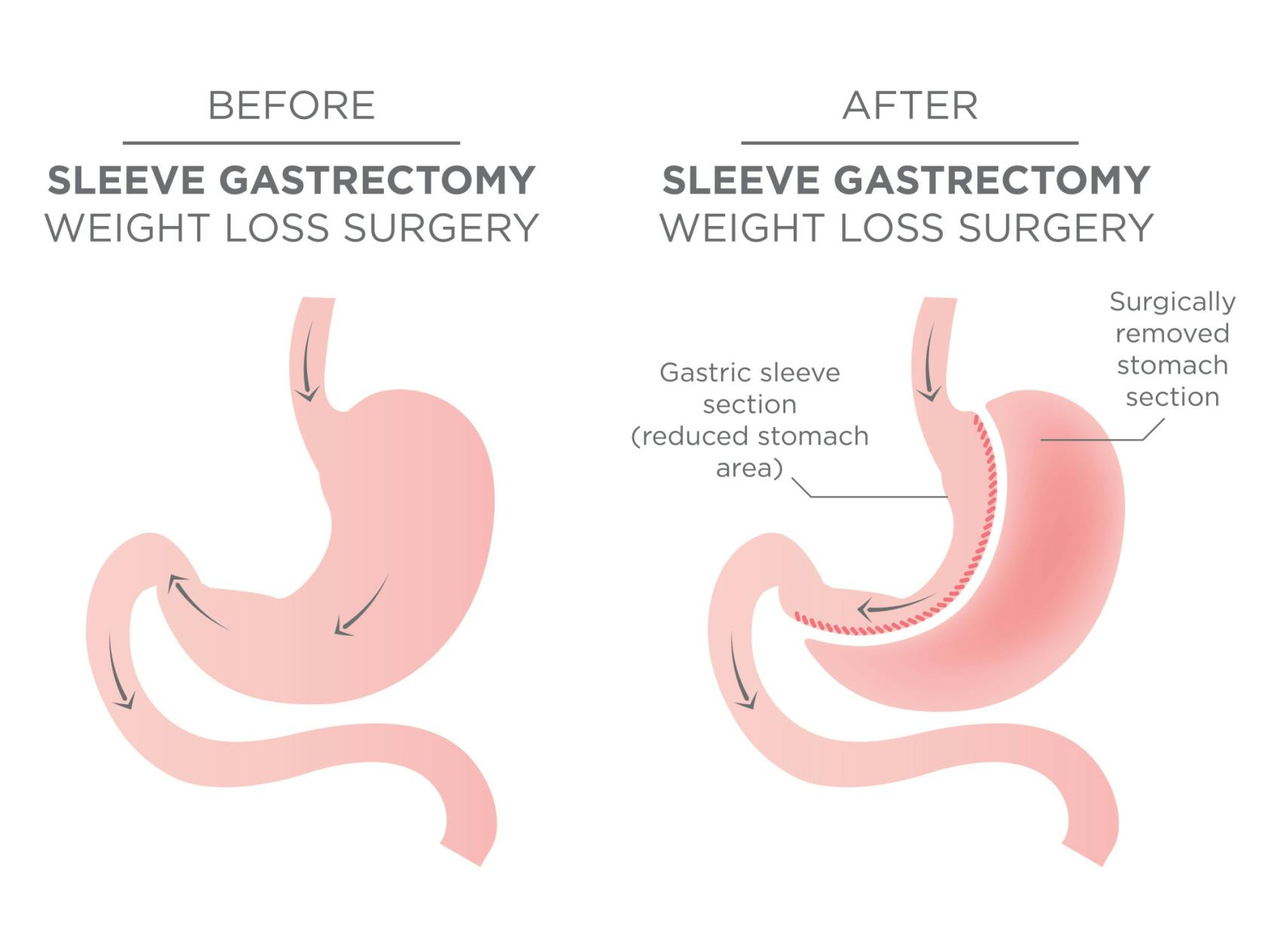 EN image 1 for Bariatric Surgery Cost Guide