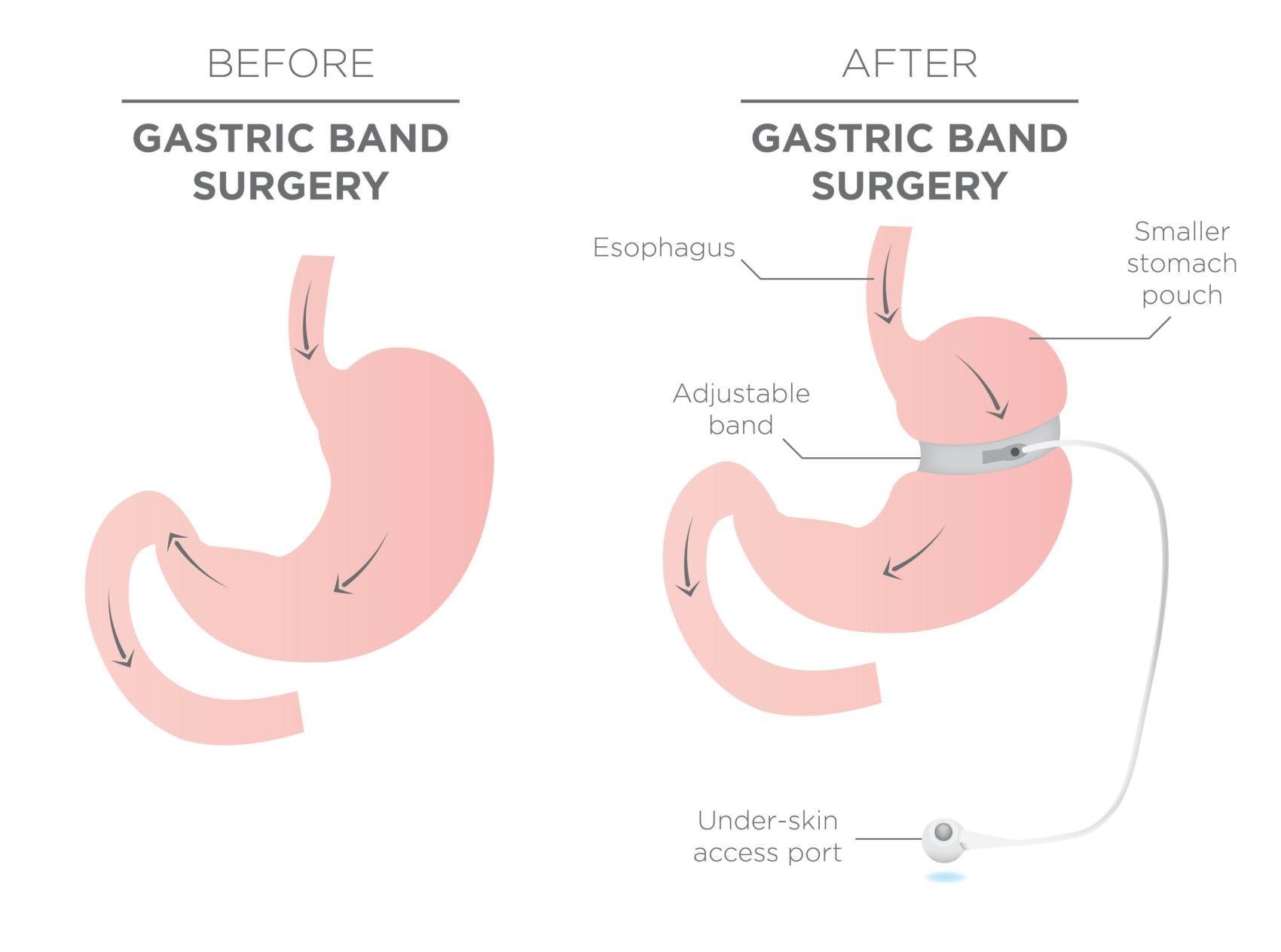 EN image 3 for Bariatric Surgery Cost Guide