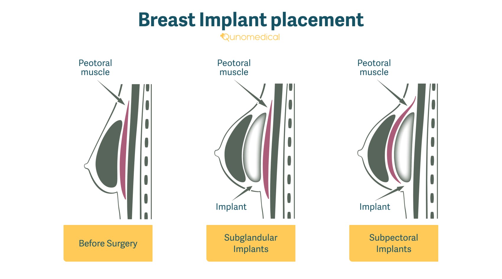 Illustration showing how breast implants are placed.