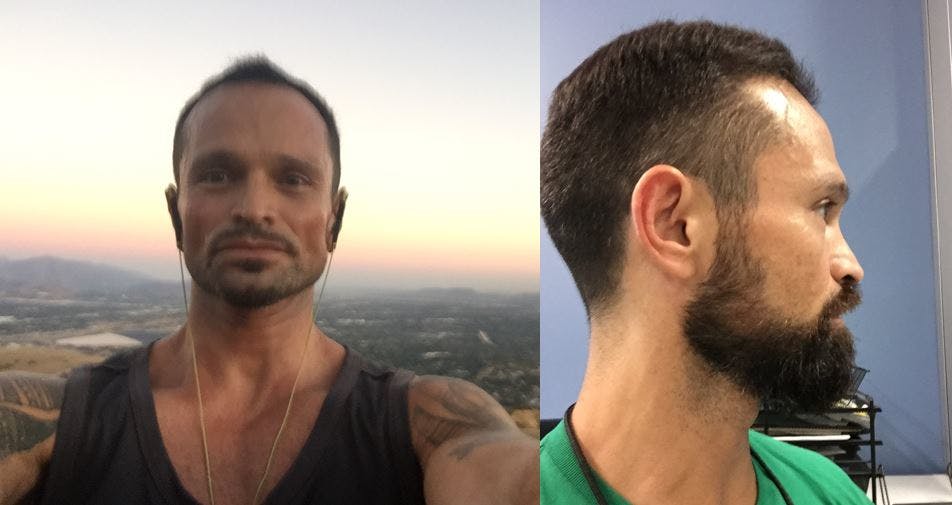 BannerImage_Freddy’s Hair Transplant: 6 Months Later