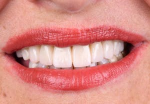 Lächelnde Frau nach Behandlung im besten Land für Zahnimplantate 