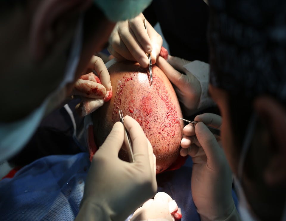 Hair Transplant: The Role of Nurses and Technicians