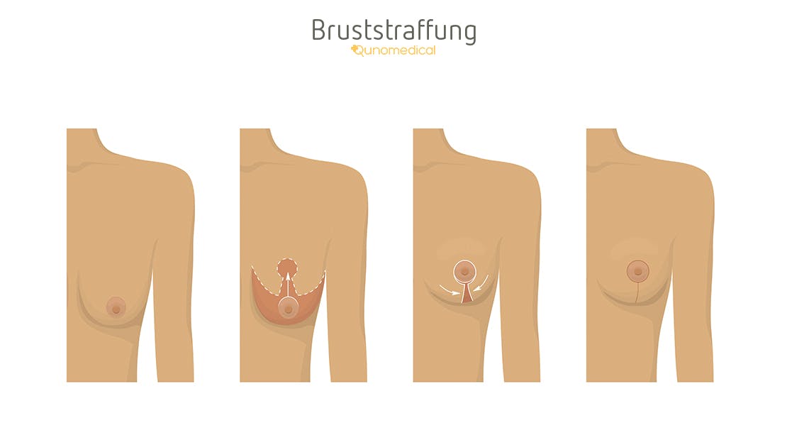 Diagramm zeigt, wie eine Bruststraffungsoperation funktioniert.