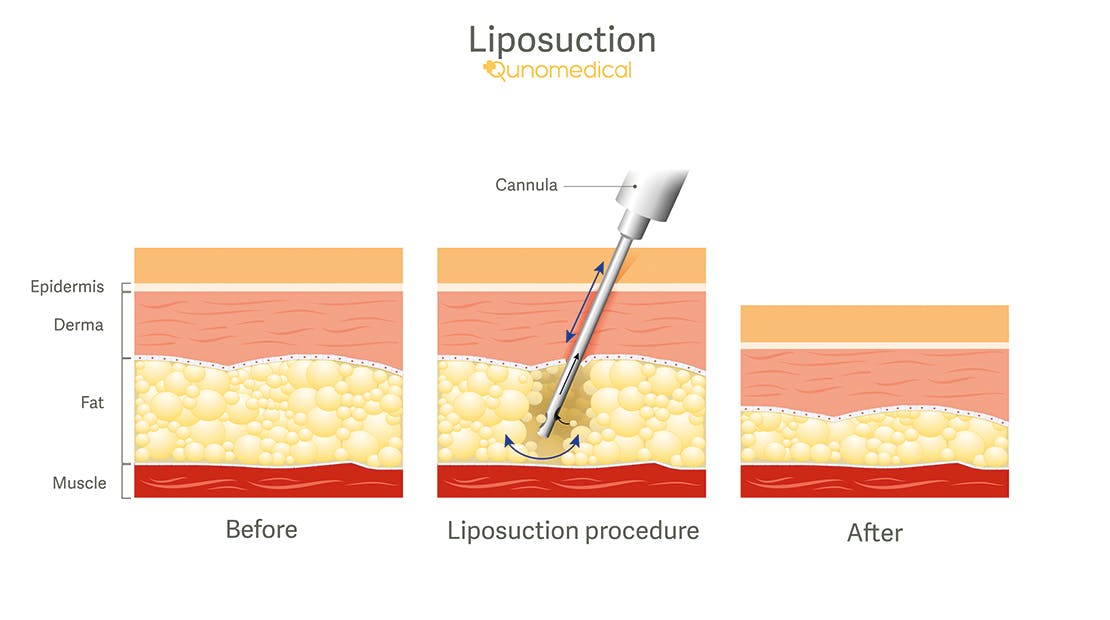Diagram showing how liposuction surgery works.