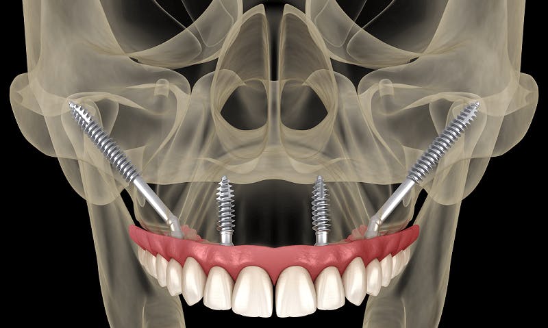 Zygomatic implant illustration