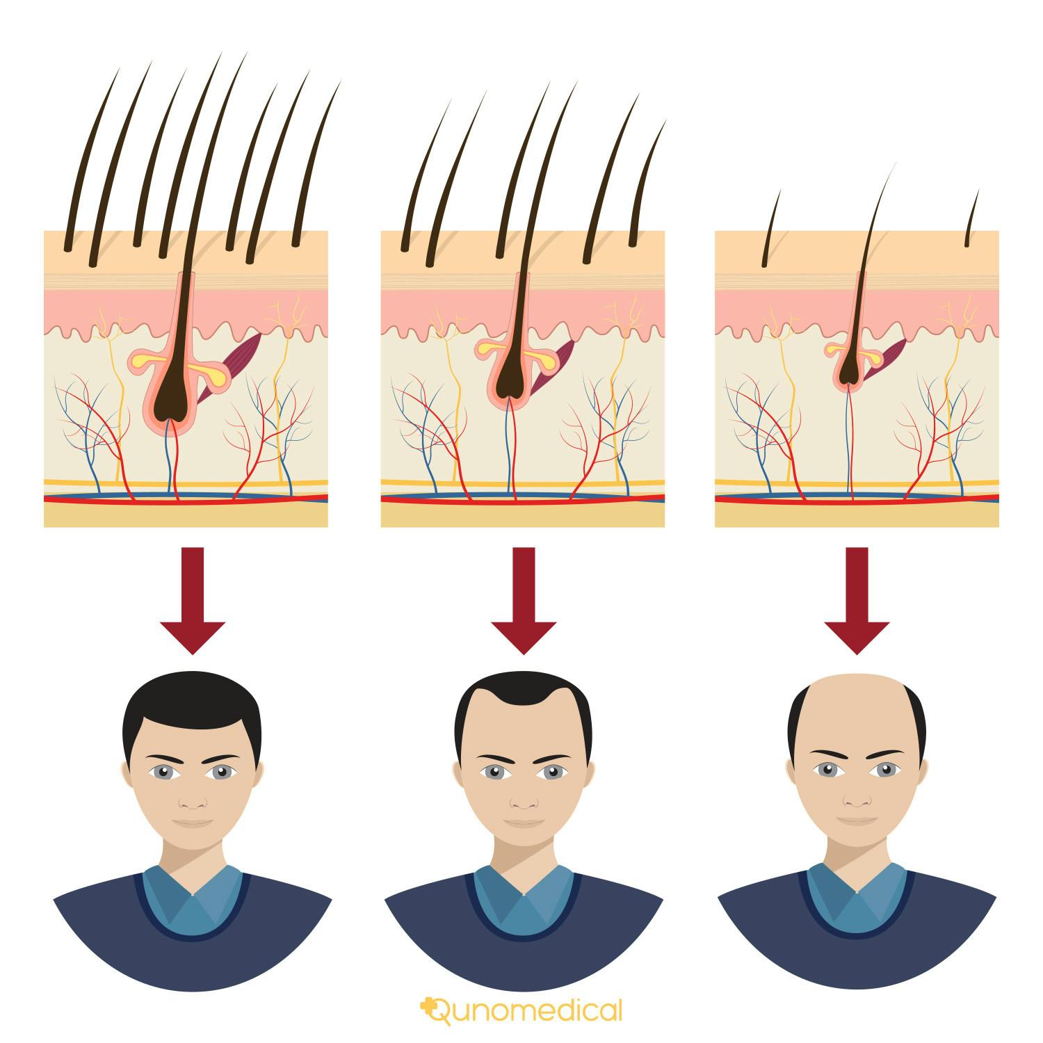 EN image 3 for Hair Loss Treatment Options - Extensive Guide